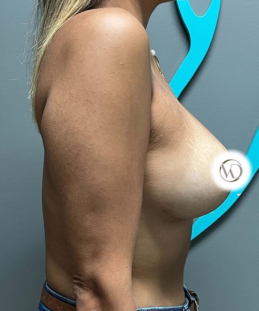 Breast Lift Implants Before & After