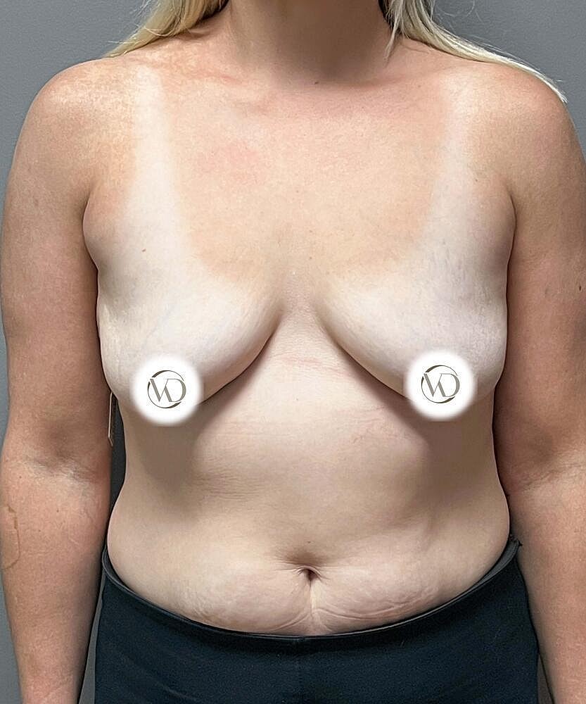 Breast Lift Implants Before & After