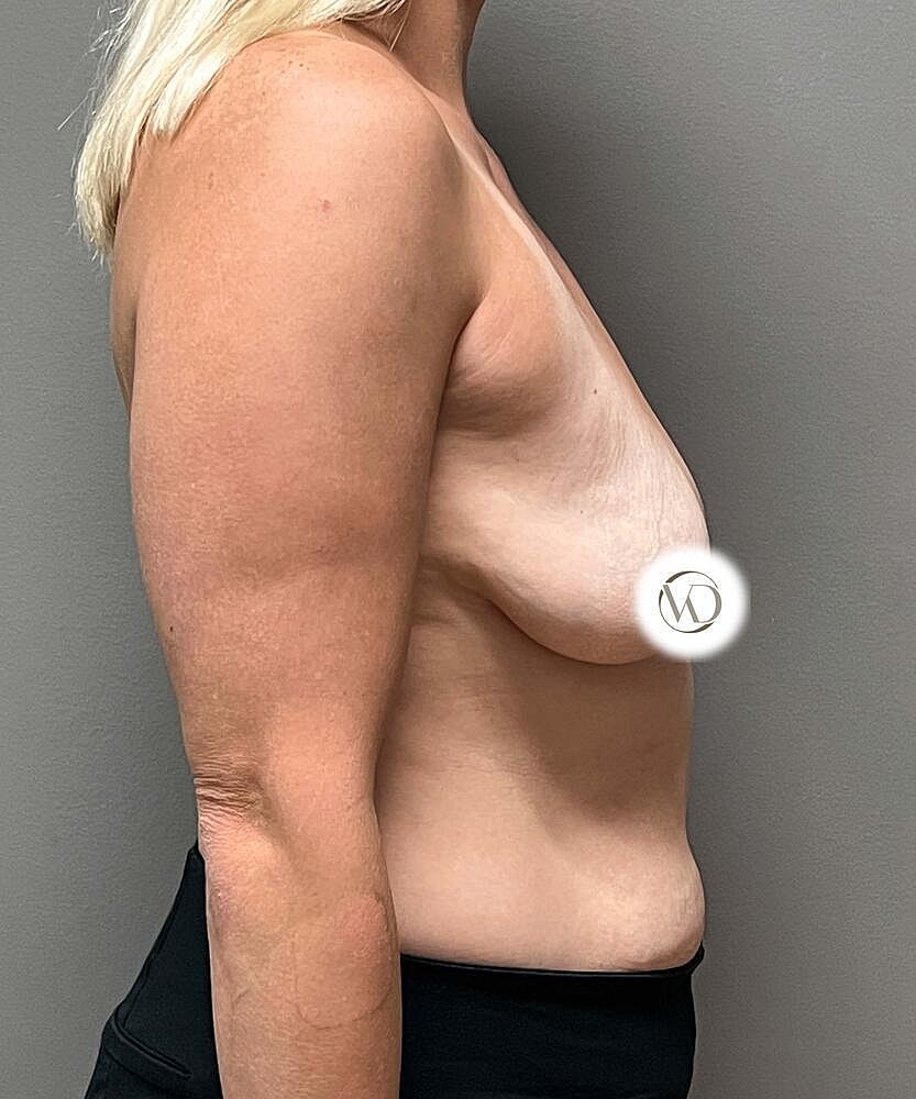 Breast Lift Implants Before & After