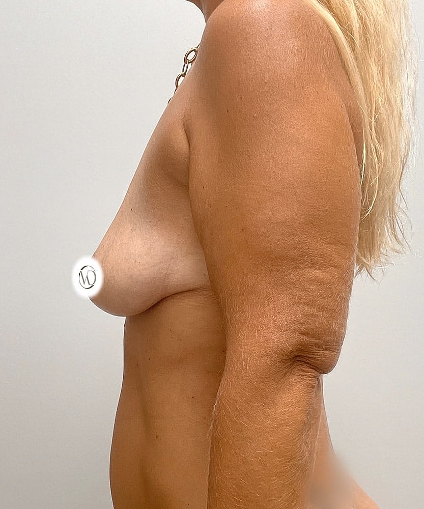 Breast Lift Implants Before & After
