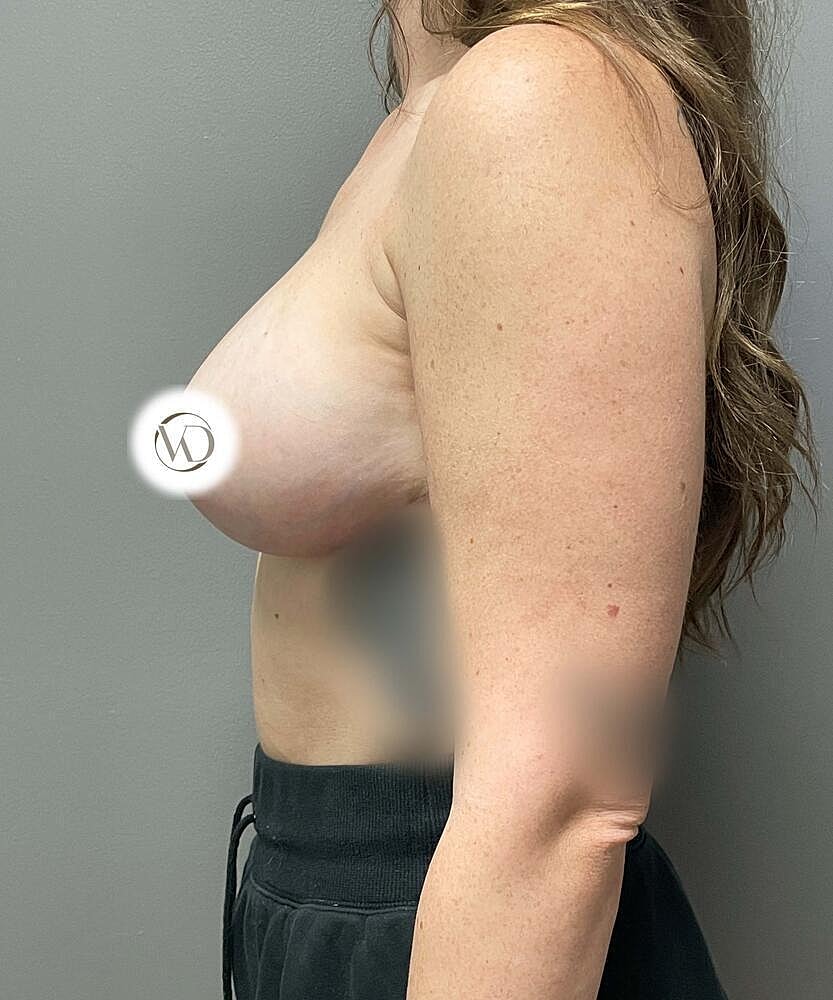Breast Lift Implants Before & After