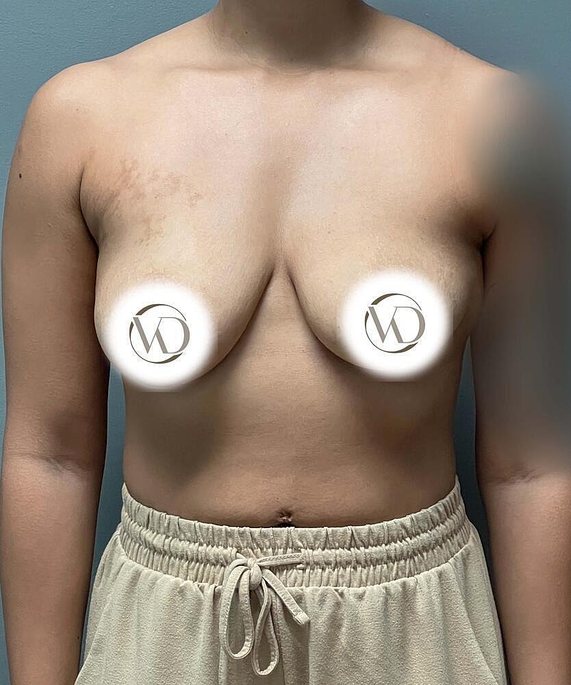 Breast Lift Implants Before & After