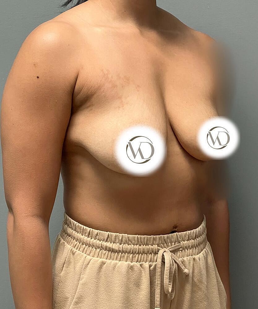 Breast Lift Implants Before & After
