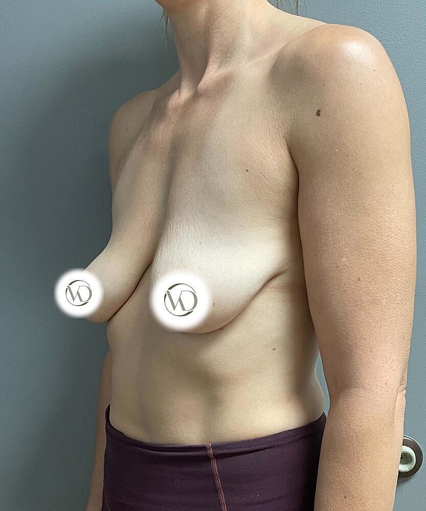 Breast Lift Implants Before & After