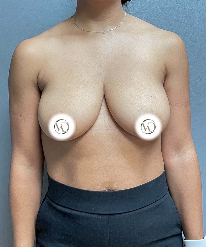 Breast Lift Implants Before & After