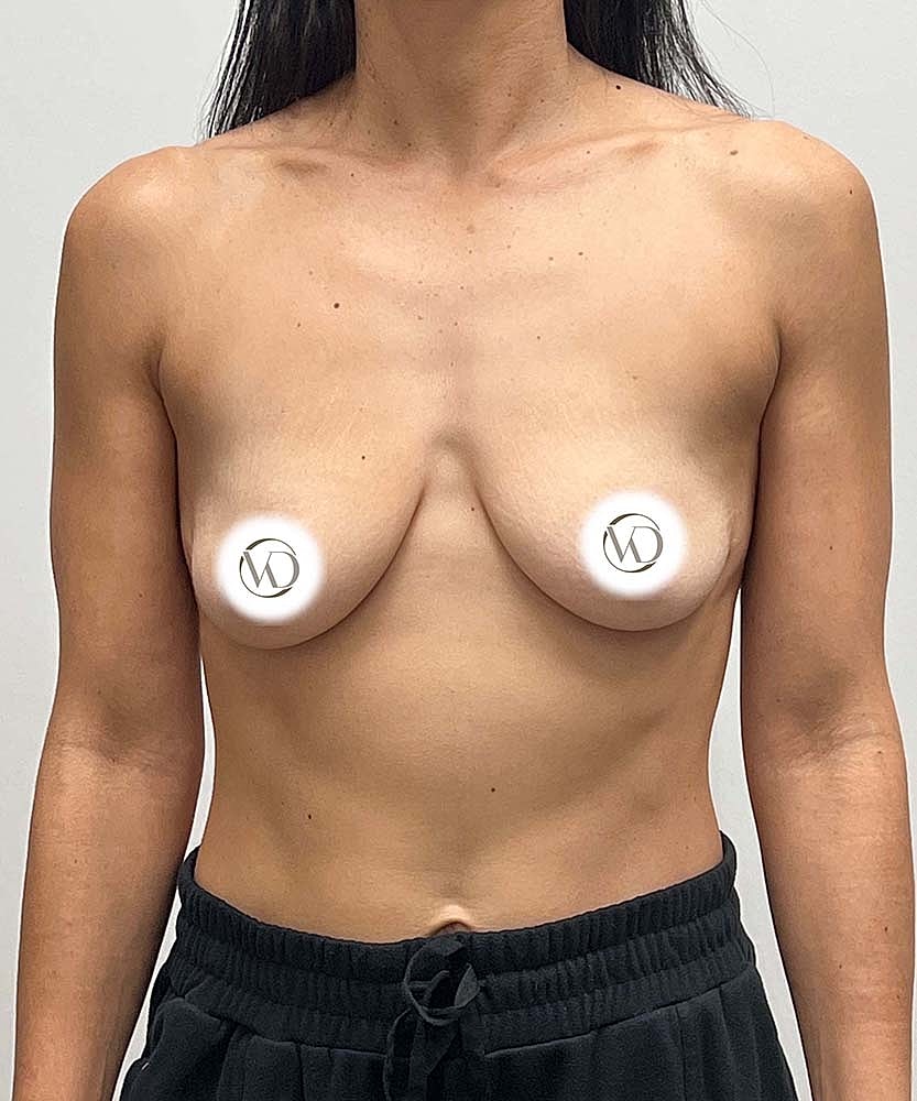Breast Lift Implants Before & After