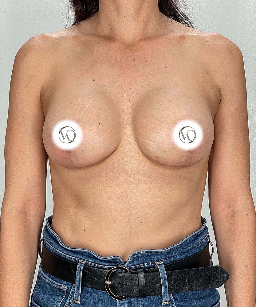 Breast Lift Implants Before & After