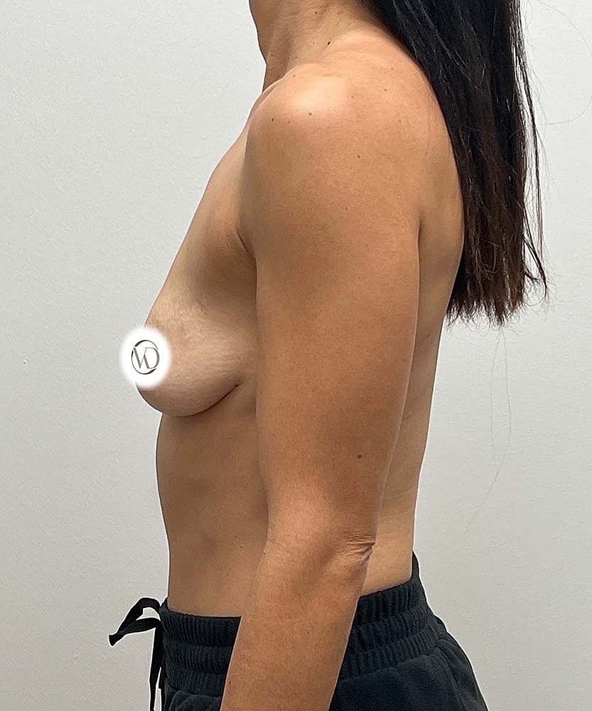 Breast Lift Implants Before & After
