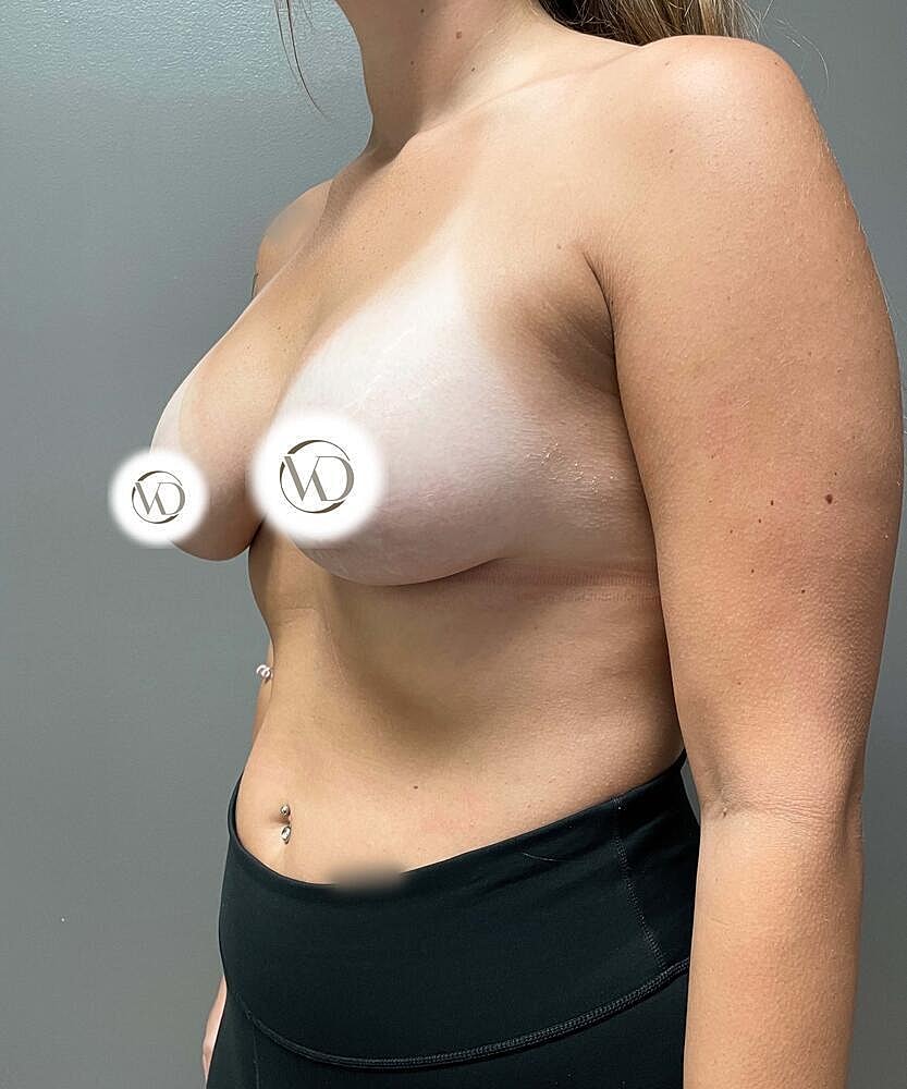 Breast Lift Implants Before & After