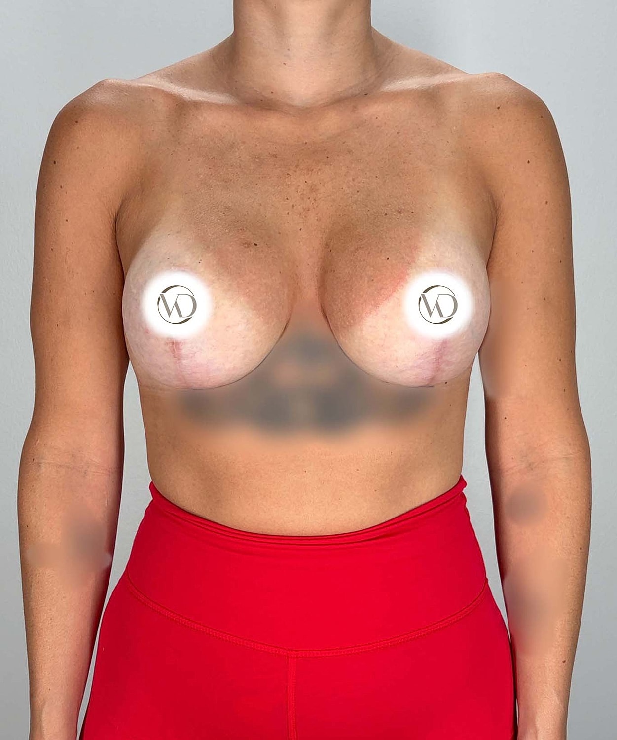Breast Lift Implants Gallery Before & After