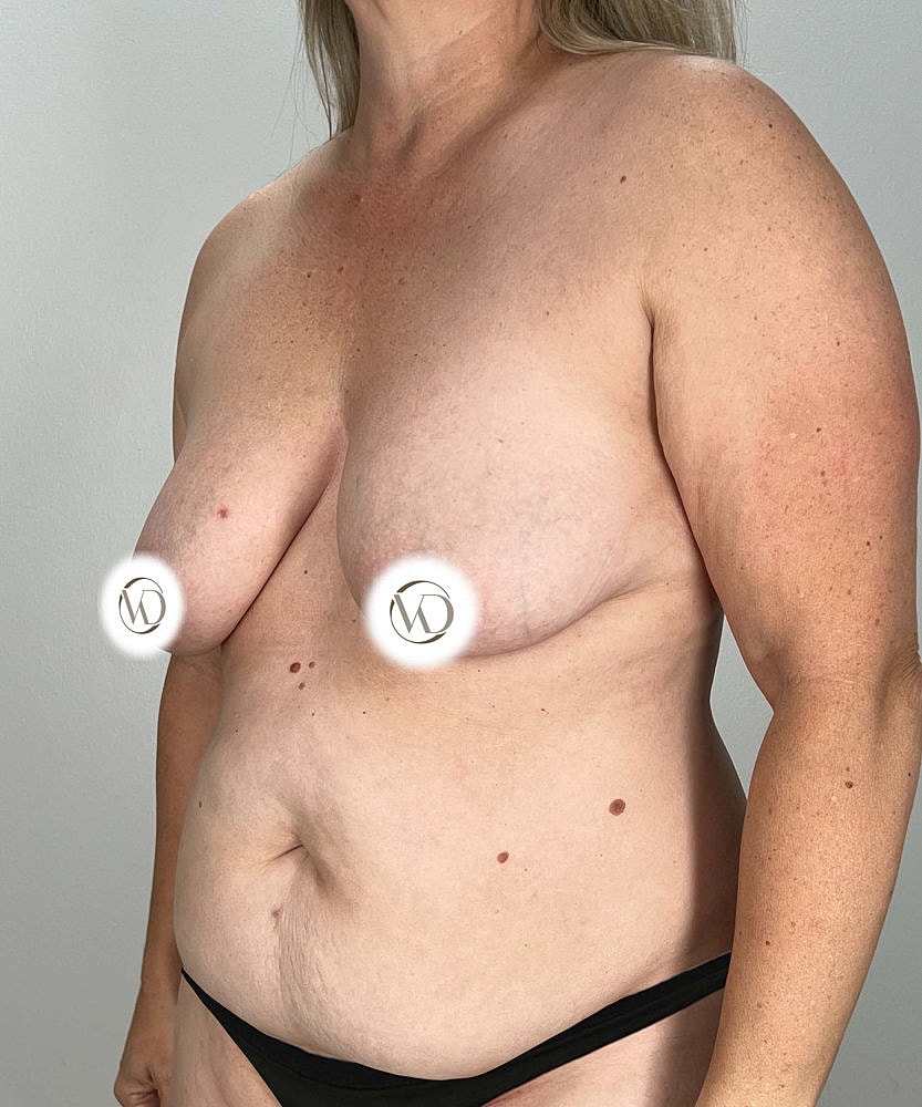 Breast Lift Implants Before & After