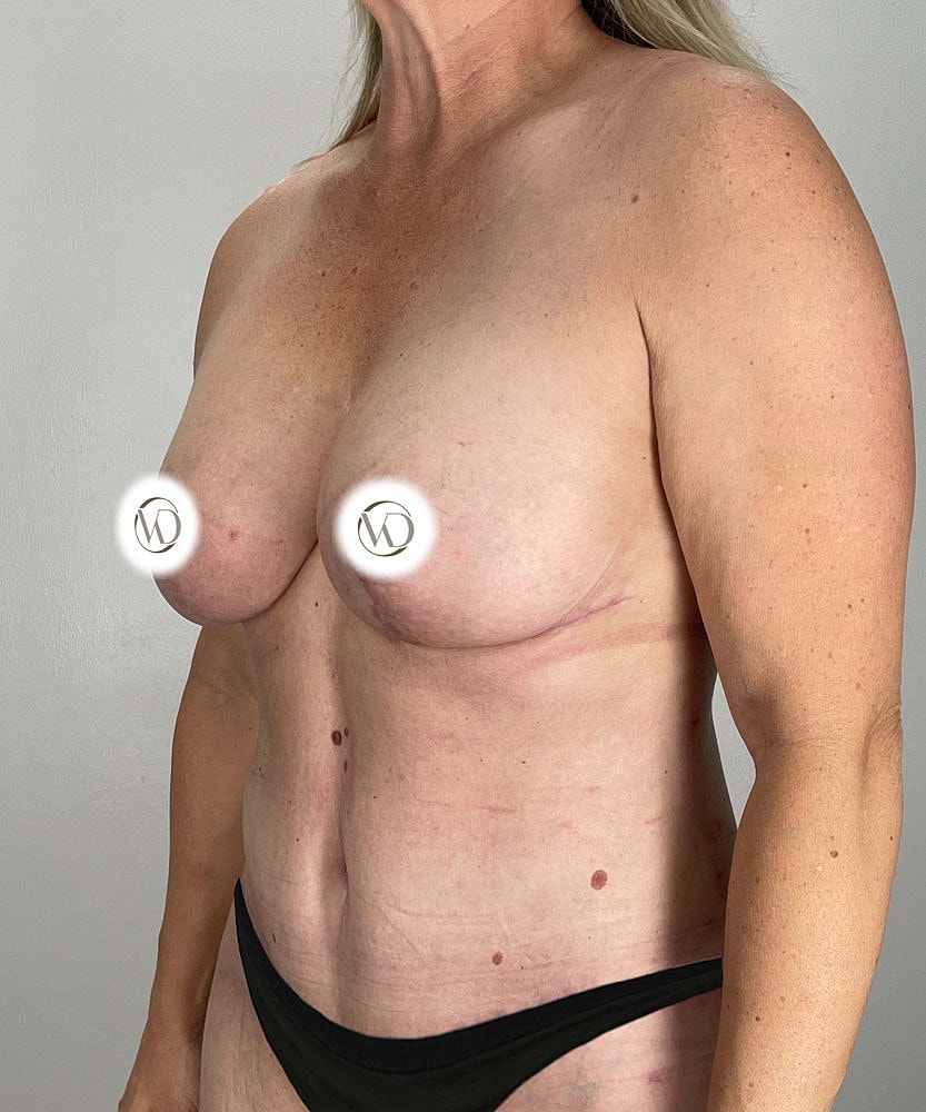 Breast Lift Implants Before & After