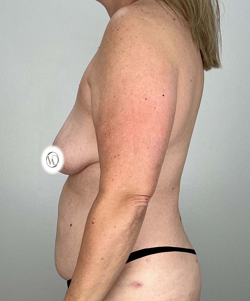 Breast Lift Implants Before & After