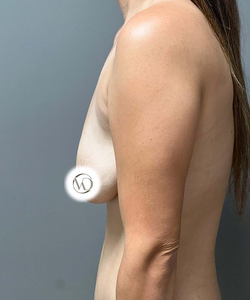 Breast Lift Implants Before & After