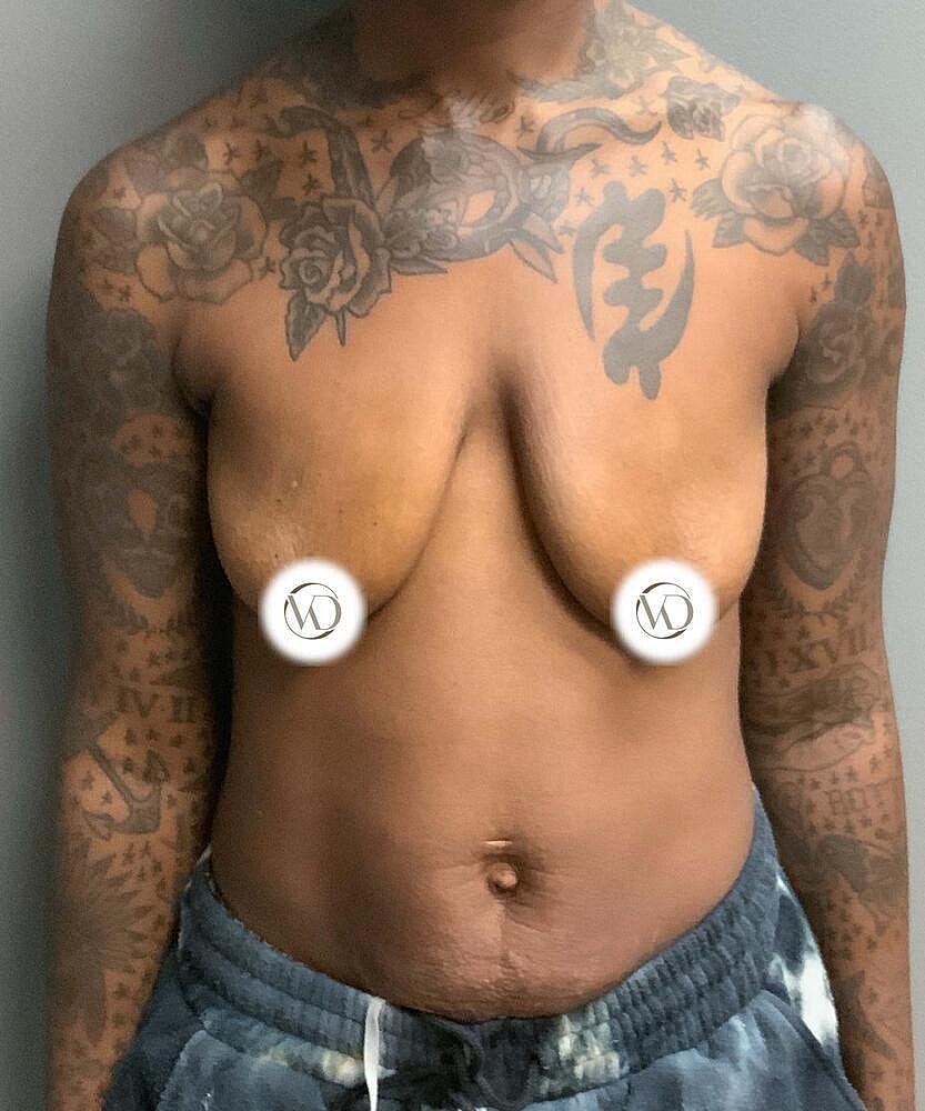 Breast Lift Implants Before & After