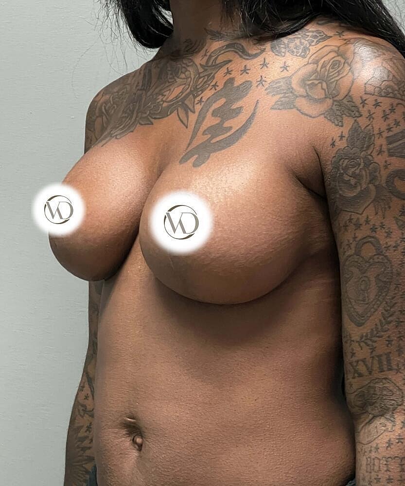 Breast Lift Implants Before & After