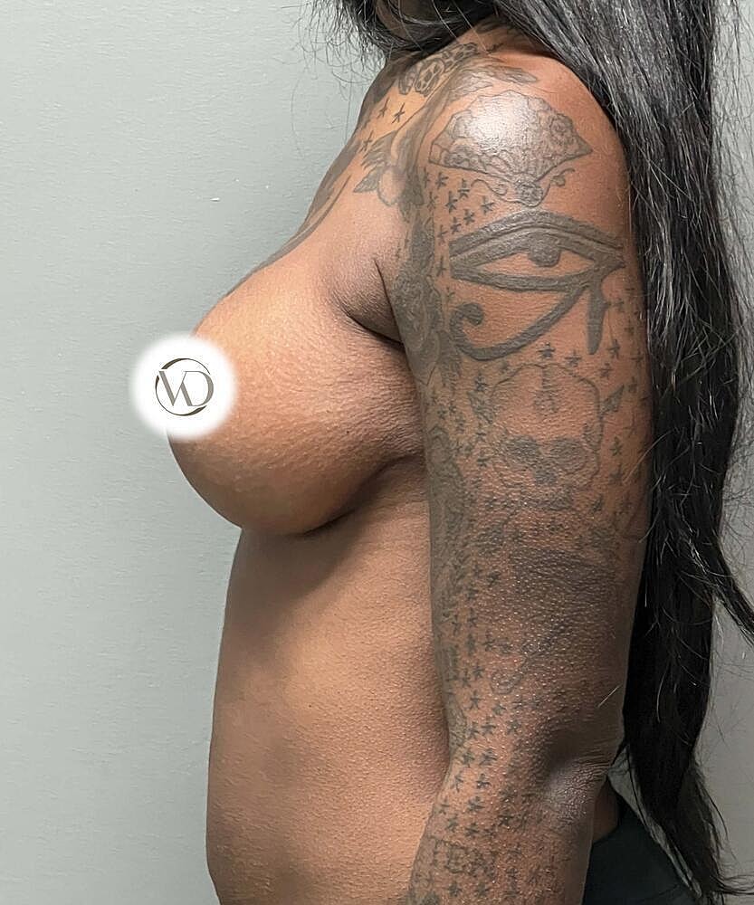 Breast Lift Implants Before & After