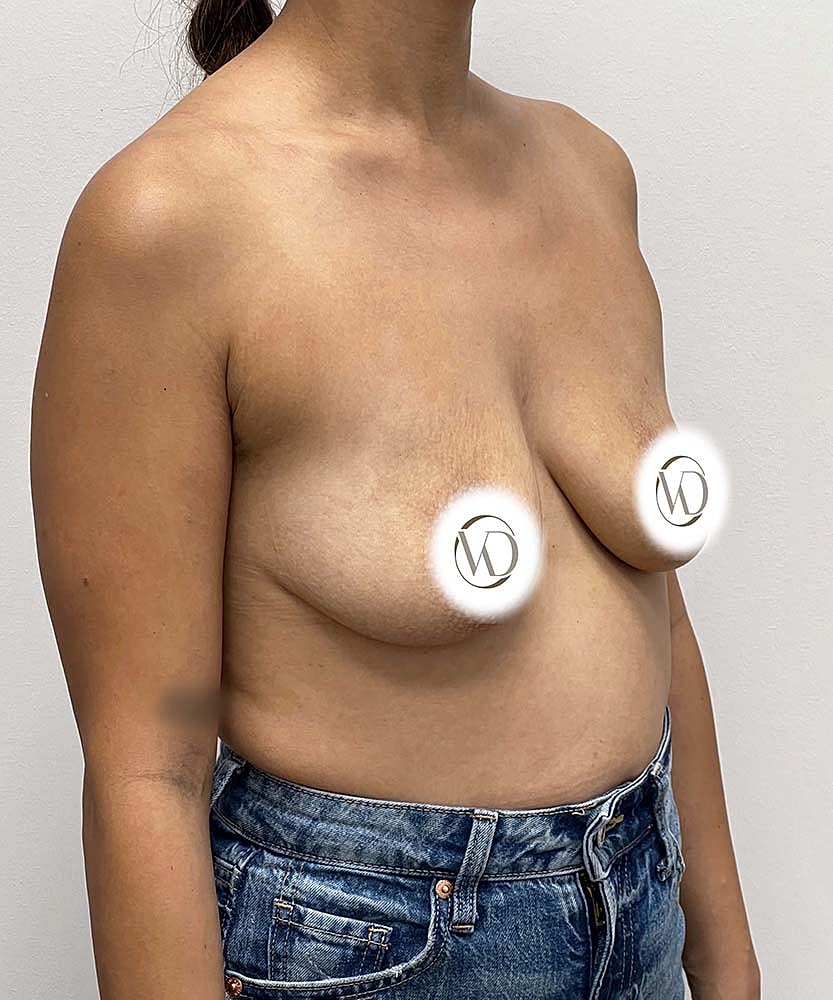 Breast Lift Implants Before & After