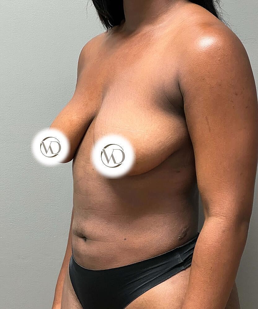 Breast Lift Implants Before & After