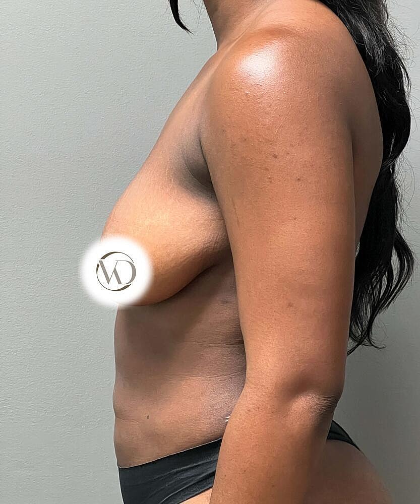 Breast Lift Implants Before & After