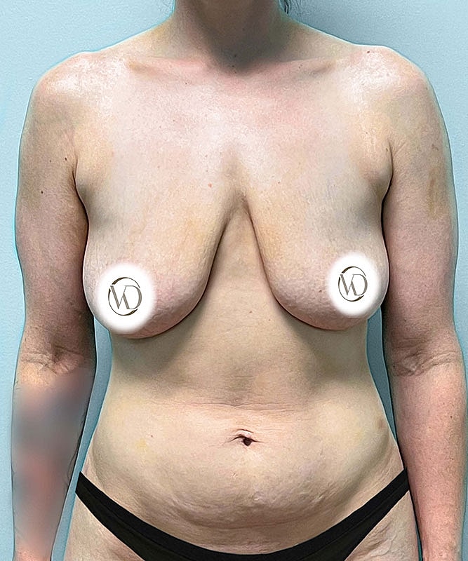 Breast Lift Implants Before & After