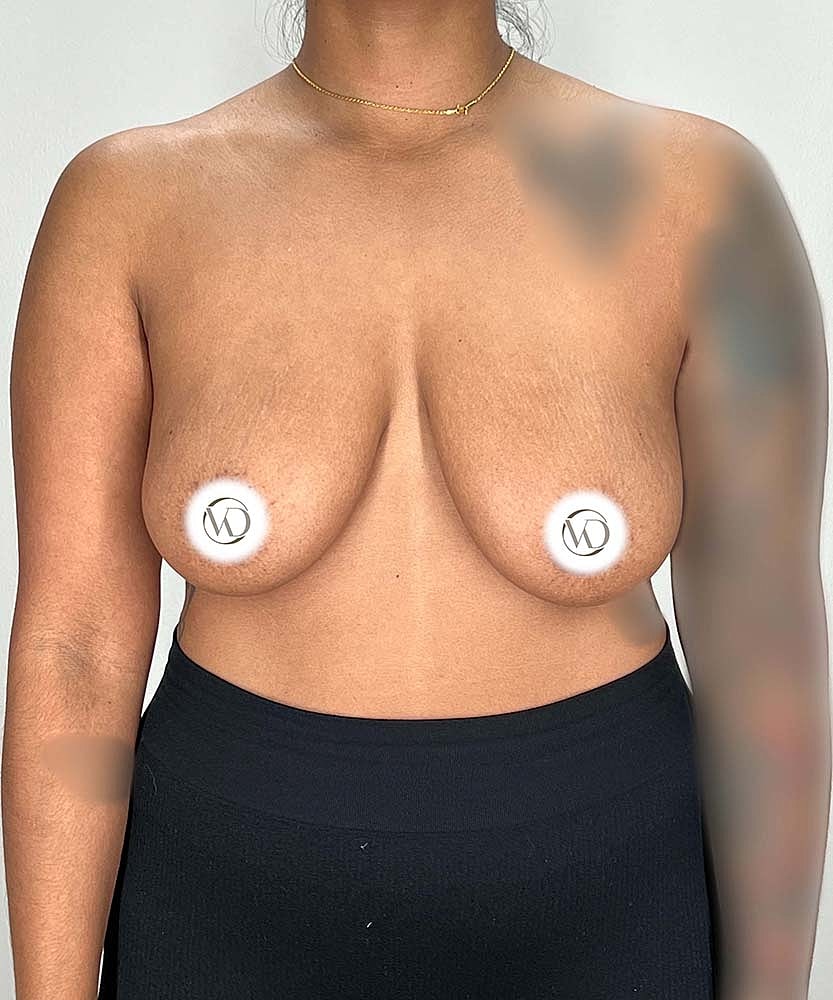 Breast Lift Implants Before & After