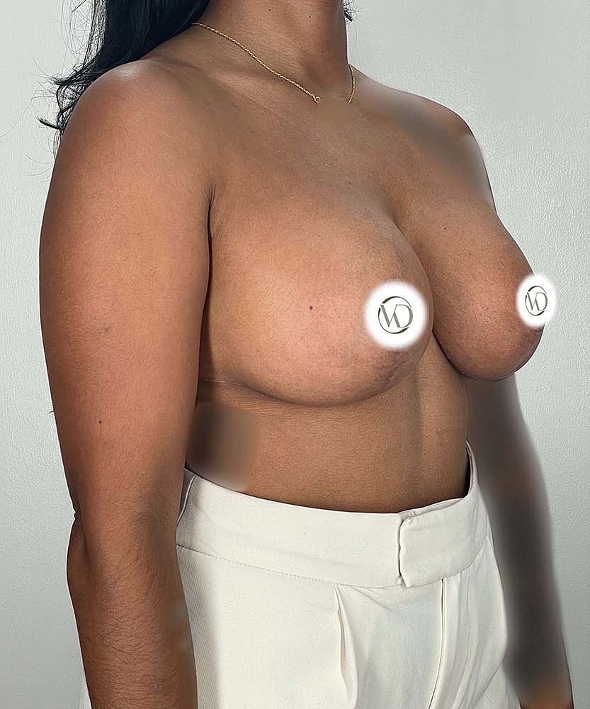 Breast Lift Implants Before & After