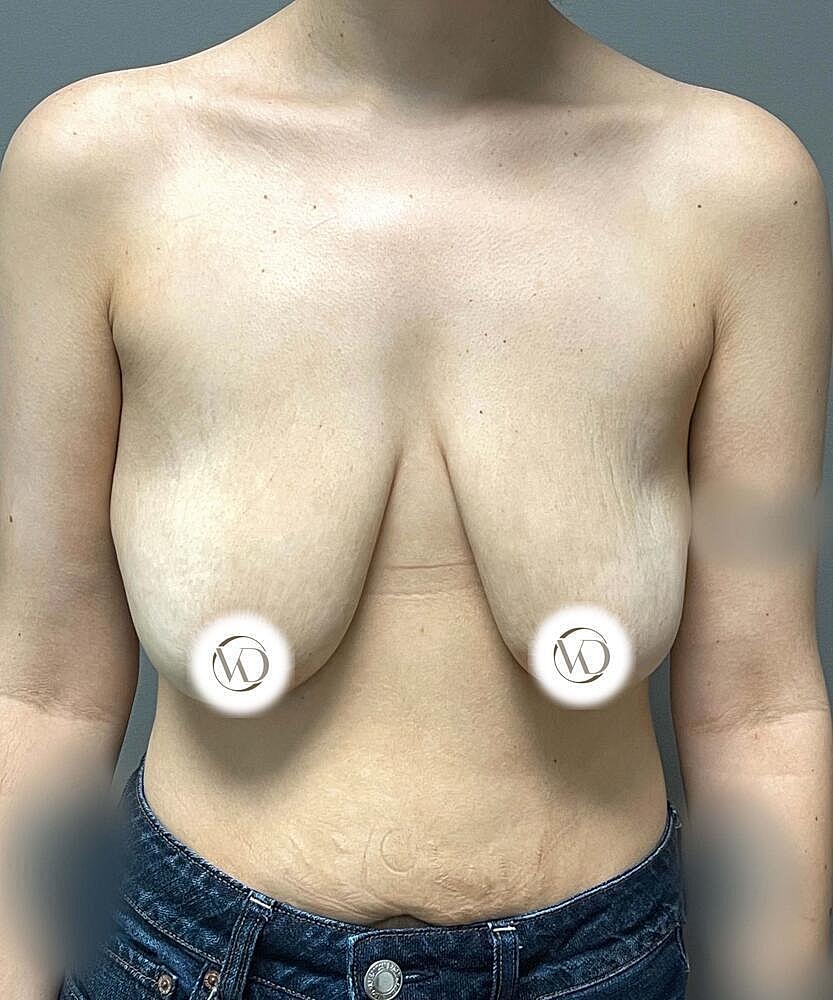 Breast Lift Implants Before & After