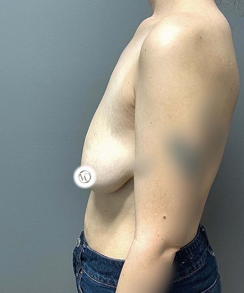 Breast Lift Implants Before & After