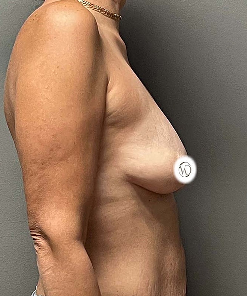 Breast Lift Implants Before & After