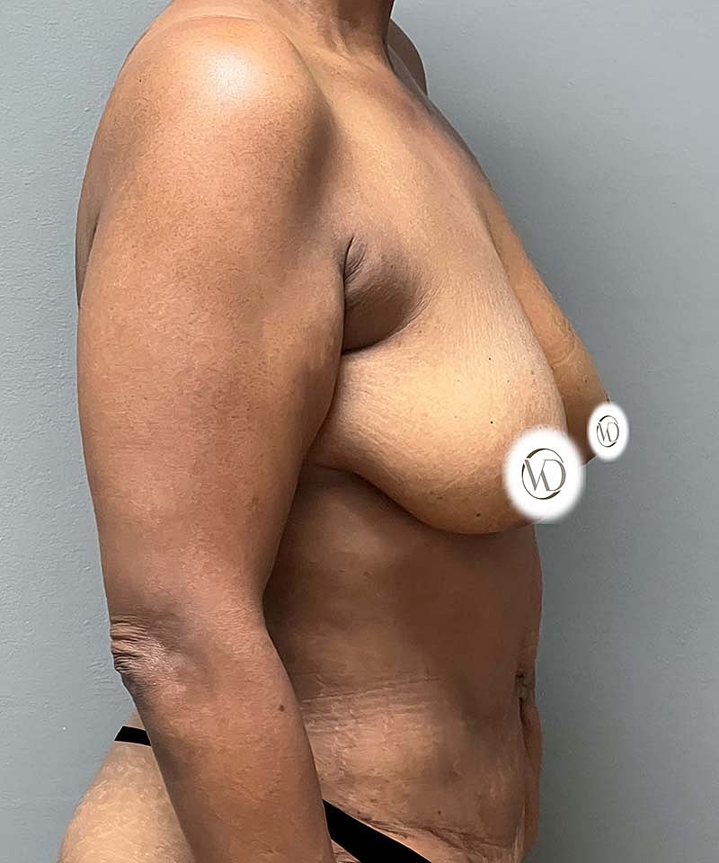 Breast Lift Implants Before & After