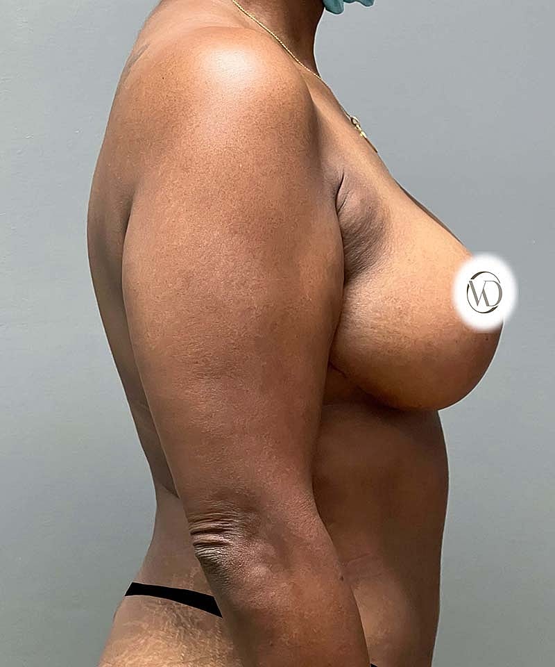 Breast Lift Implants Before & After