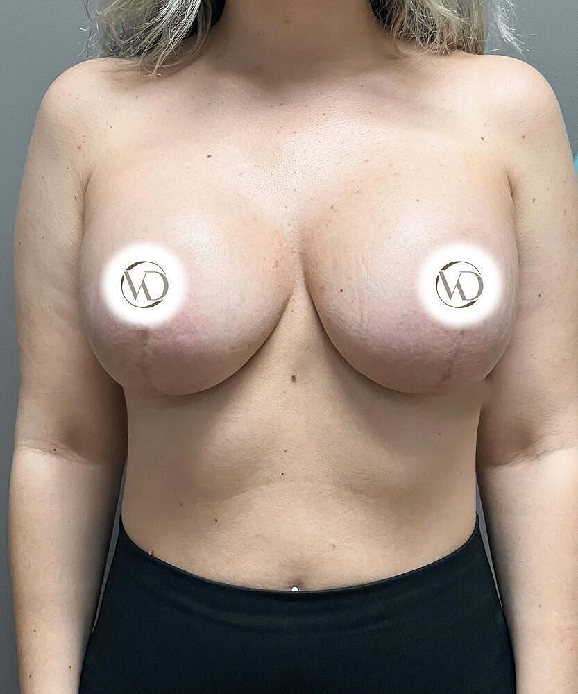 Breast Lift Implants Before & After