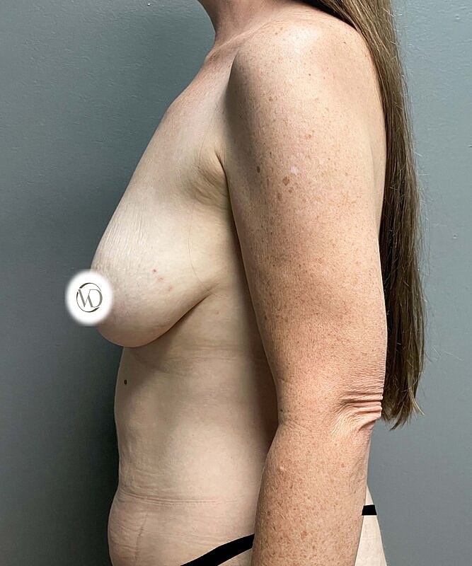 Breast Lift Implants Before & After