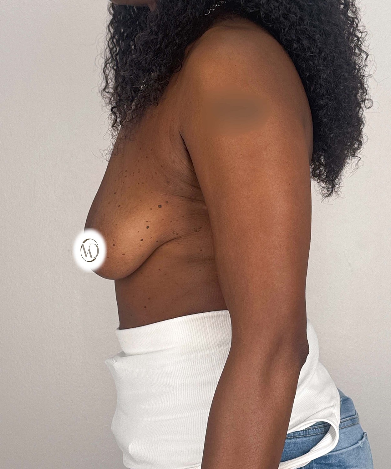 Breast Lift Implants Gallery Before & After