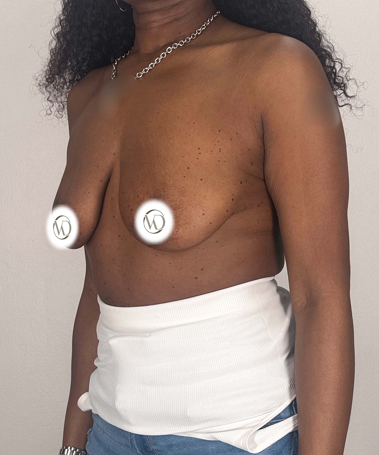 Breast Lift Implants Gallery Before & After