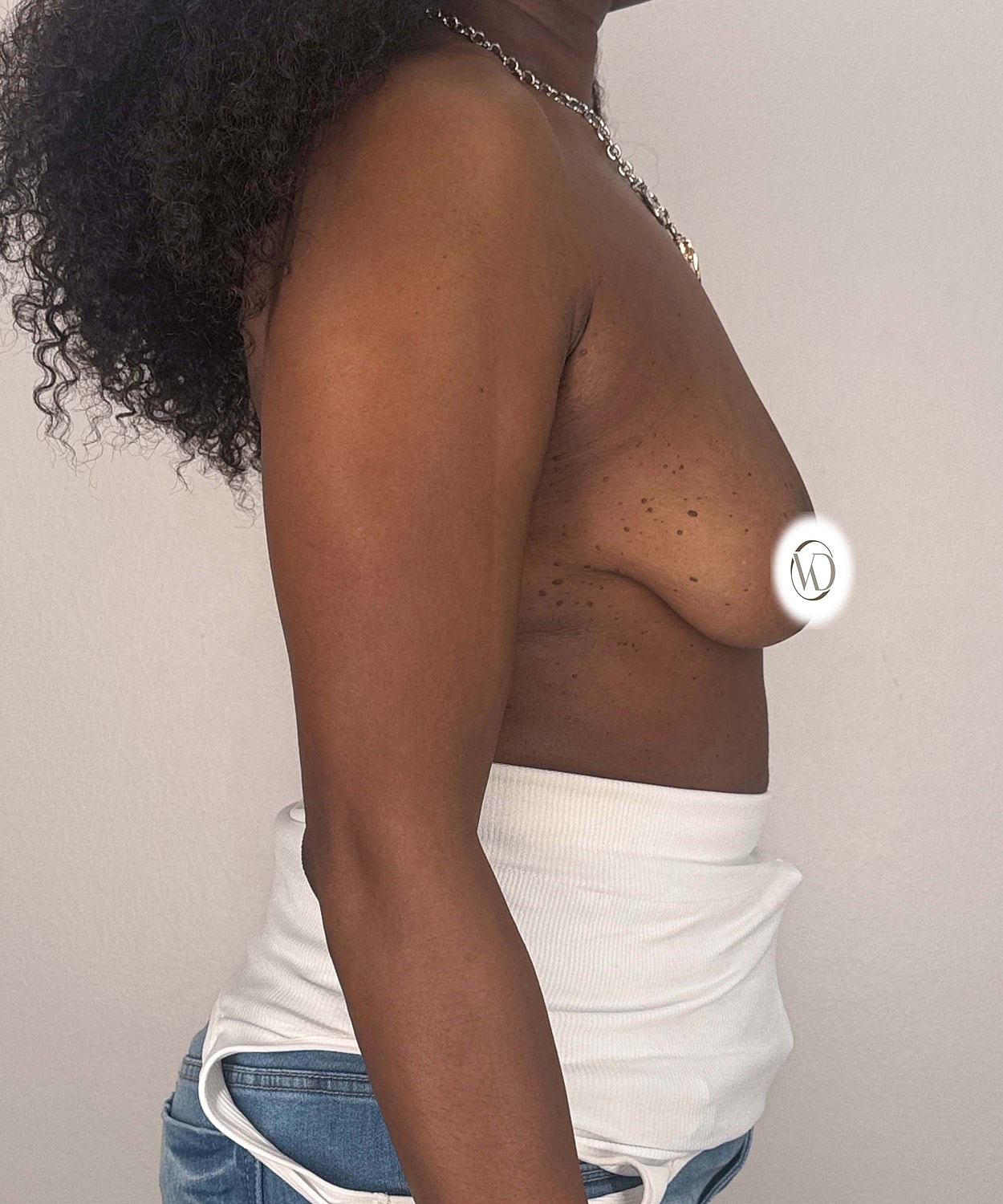 Breast Lift Implants Gallery Before & After