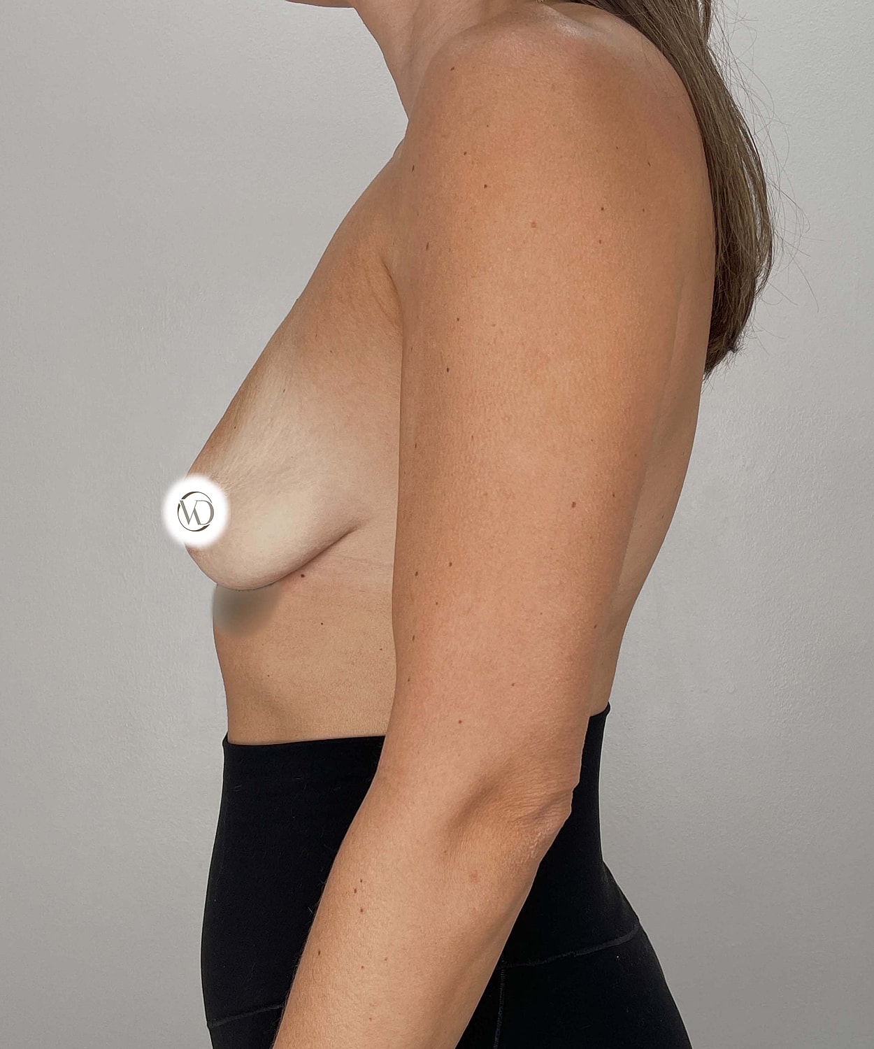 Breast Lift Implants Gallery Before & After