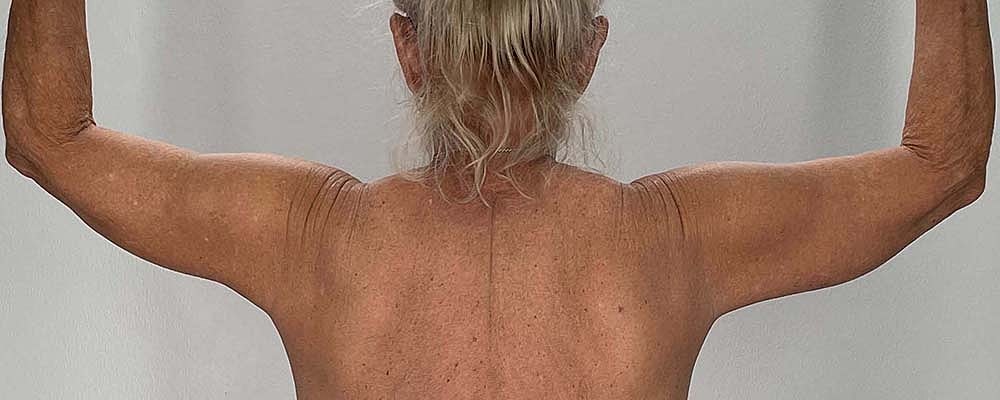 Arm Lift Before & After