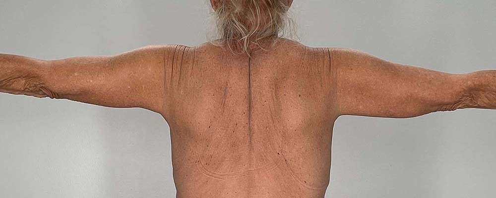 Arm Lift Before & After