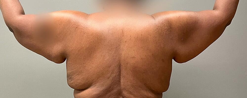 Arm Lift Before & After