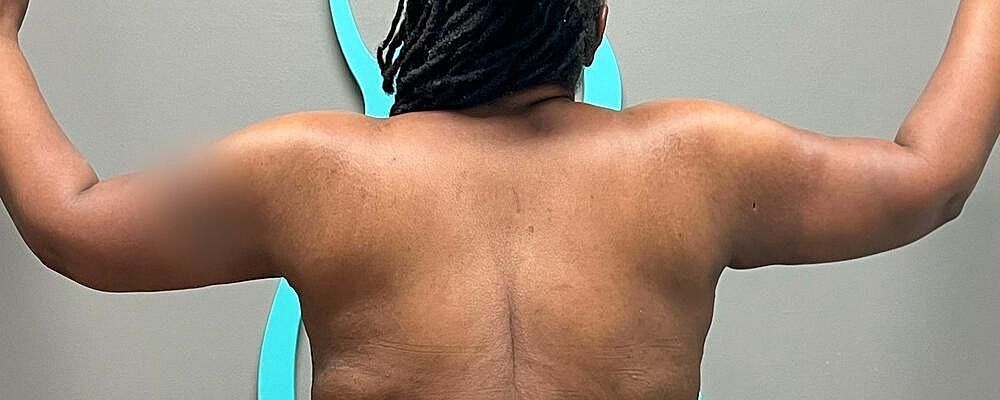 Arm Lift Before & After