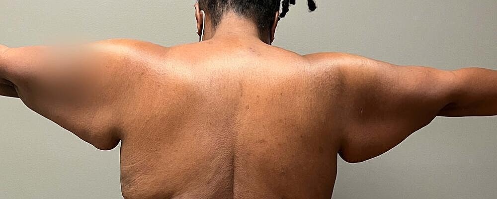 Arm Lift Before & After