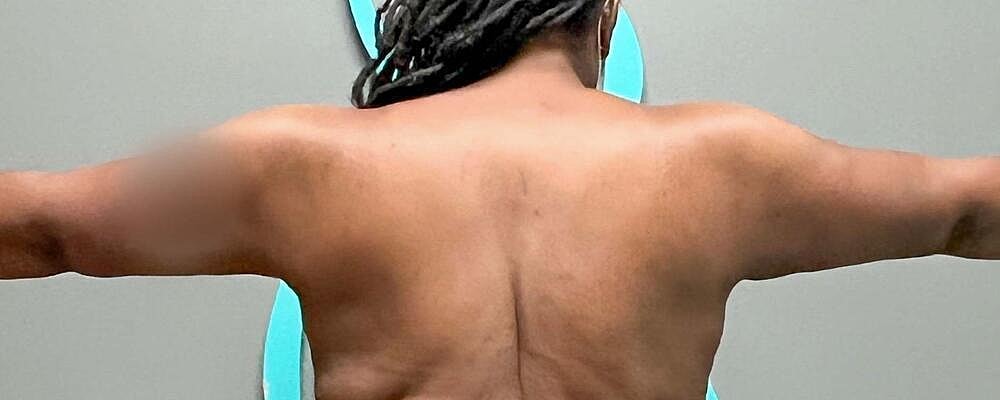 Arm Lift Before & After
