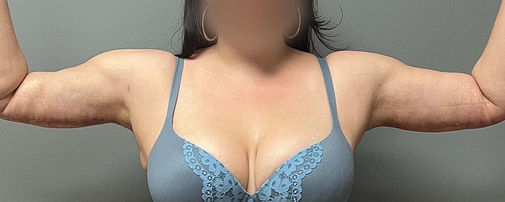 Arm Lift Before & After