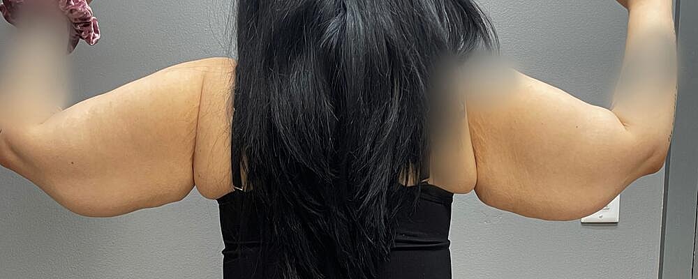 Arm Lift Before & After