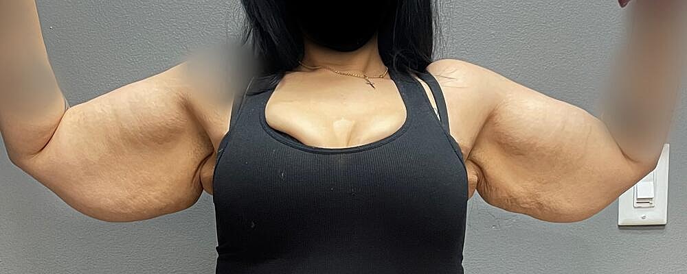 Arm Lift Before & After