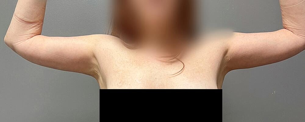 Arm Lift Before & After