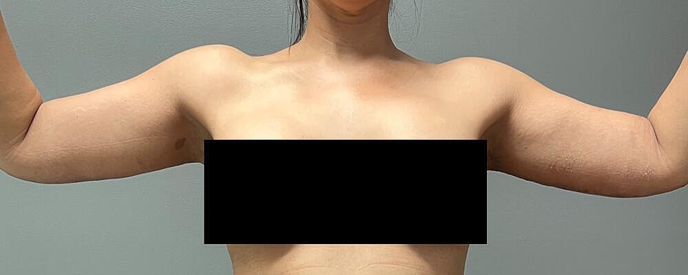 Arm Lift Before & After