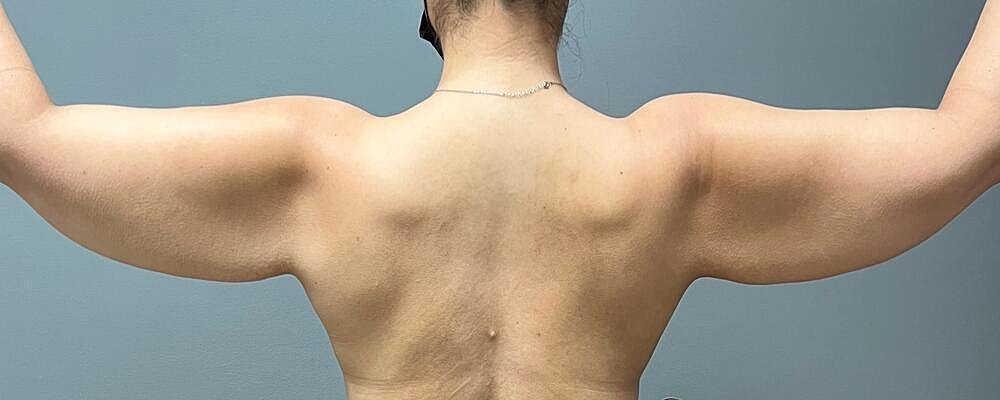 Arm Lift Before & After